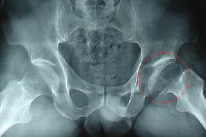 小兒股骨頭壞死 小兒股骨頭壞死