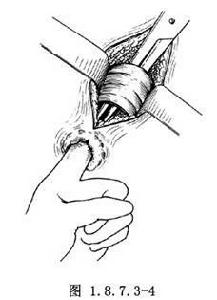 恥骨直腸肌綜合症手術 恥骨直腸肌綜合症手術