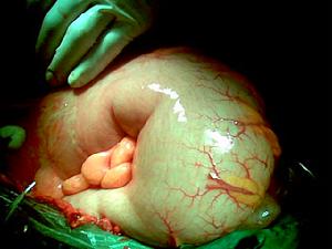 潰瘍病急性穿孔 潰瘍病急性穿孔