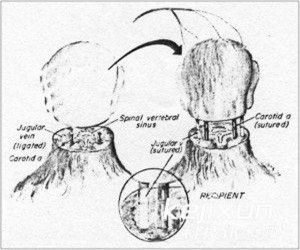 腦組織移植 腦組織移植