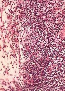 成人肥大性幽門狹窄