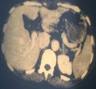 假性醛固酮增多症