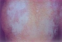 口腔扁平苔蘚 口腔扁平苔蘚