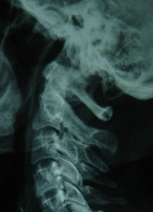 缺血性肌攣縮 缺血性肌攣縮