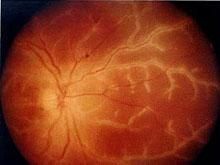 血灌瞳神 血灌瞳神