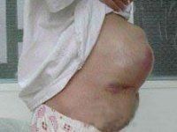 肌肉纖維瘤 肌肉纖維瘤