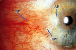 眼外肌廣泛纖維化綜合徵