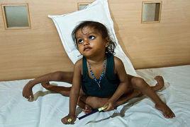 蜘蛛女孩[印度畸形兒]