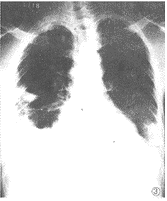 腦膜炎奈瑟菌肺炎