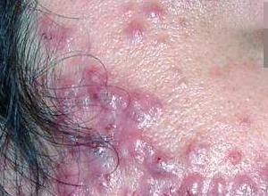 右邊臉頰長痘 右邊臉頰長痘