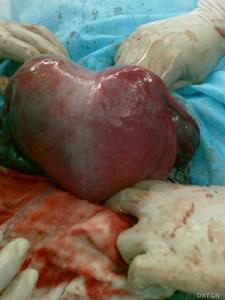 鞍狀子宮 鞍狀子宮