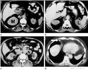 腎細胞癌 腎細胞癌
