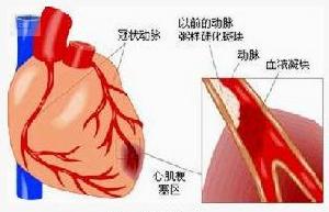 糖尿病性心臟病