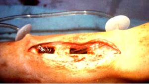 慢性化膿性骨髓炎