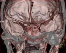 腦動脈炎 腦動脈炎