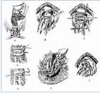 直腸前壁摺疊術 直腸前壁摺疊術