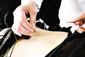 針灸減肥時如果用針太頻太狠容易產生“穴位疲勞”，不利於身體健康