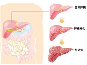 肝炎後肝硬化