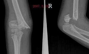 骨化性肌炎 骨化性肌炎