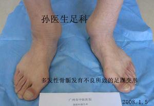 多發性骨骺發育不良