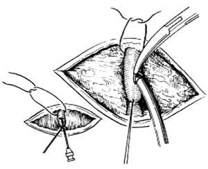 靜脈切開術 靜脈切開術