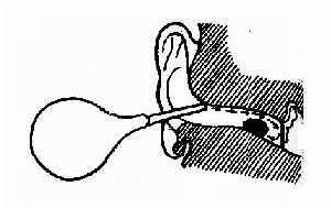 耵聹栓塞 耵聹栓塞