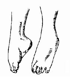 維生素D缺乏型手足搐搦症