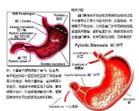 幽門梗阻 幽門梗阻