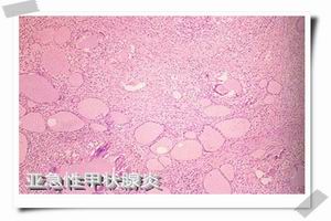 慢性自身免疫性甲狀腺炎