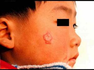 孢子絲菌病 孢子絲菌病