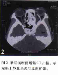 頸內動脈海綿竇瘺