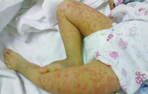 噬血細胞綜合徵——皮下出血