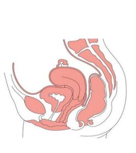 宮頸囊腫 宮頸囊腫