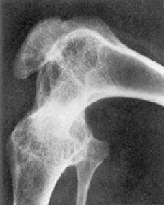 關節骨性強直 關節骨性強直