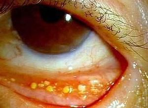 結膜異物 結膜異物