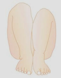 拉塞格征 拉塞格征