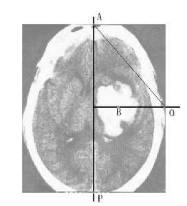 顱內占位性病變