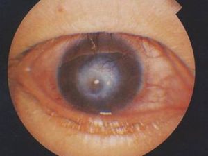 神經麻痹性角膜炎 神經麻痹性角膜炎