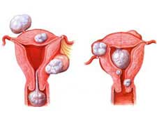 （圖）妊娠合併子宮肌瘤