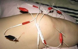 電針療法 電針療法