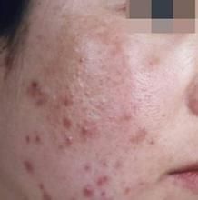 囊腫性痤瘡 囊腫性痤瘡