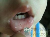 口唇皰疹 口唇皰疹