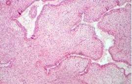 乳腺纖維腺瘤組織切片