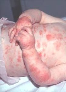 兒童食物過敏 兒童食物過敏