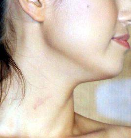 吻痕[機械性紫斑]