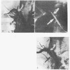 鎖骨下動脈盜血綜合徵