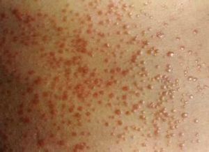 膽鹼性蕁麻疹 膽鹼性蕁麻疹