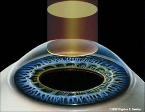 準分子雷射矯正近視手術