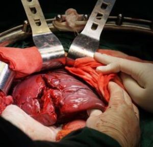 肝臟破裂 肝臟破裂