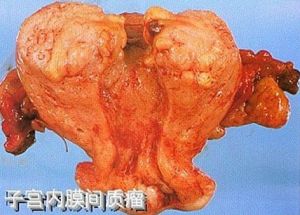 陰道子宮內膜間質肉瘤